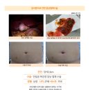 담석2.3cm수술후기. 국내 체류시간이 짧은 상황에서 원하는 시기에 빠른 검진과 수술을 받을 수 있어서 감사합니다. 이미지