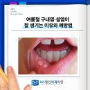 행신역치과 :여름철 구내염, 설염이 더 자주 생기는 이유와 예방법