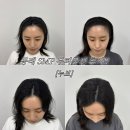 원하진헤어 | 동래 SMP 두피문신 잘하는 곳 누브 후기, 정수리 헤어라인 3회차 전후 변화 [누브]