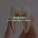 크라운, 어떤 치료인지 정확하게 알고 계신가요? | 신사역 디앙치과