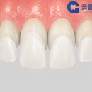 칠곡명인치과의원 | 대구 칠곡 라미네이트 수명과 교체 시기가 궁금합니다