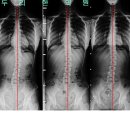 측만증이 있었던 교통사고 환자의 후유증 치료 사례 이미지