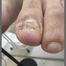 발톱닥터 | 일산내성발톱 고민될 때 찾은 식사동발톱닥터 발톱교정 후기