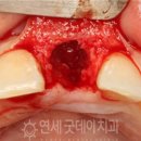선진치과기공소 | 20대 임플란트 후기 (부러진 앞니)