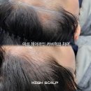 하이스칼프 | 부산 헤어라인 두피문신, 자연스러움 끝판왕? 하이스칼프에서 직접 받은 솔직 후기 (Before&amp;After 대방출)