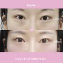 휴먼성형외과의원 | 눈밑지방재배치, 왜 할까? 성형외과전문의가 직접 알려주는 3가지 이유