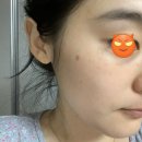 논현이화약국 | 내돈내산 -잡티레이져 후기, 루비레이져 솔직 후기, 루비레이져 장단점 (전,후 비교) 사진 많음주의
