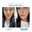 회정미술관 | 포텐자 모공 관리 피부과 시술 주기 가격 후기 공유