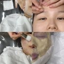 월평새뜸로 | 대전 피부관리실 화앤유 안 아픈 여드름 압출