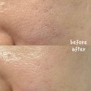 (주)바이오덴트 하단점 | 바이오드론 필오프팩 모공 축소 대박 리얼 후기 있음