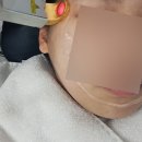 루미에의원 | [강남 피부과] 엑셀v레이저 가격 효과 본 후기ㅣ루미에의원