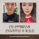 신논현역피부과 온다리프팅 후기