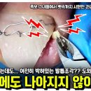 내성발톱 수술 후에도 나아지지 않아요... 도와주세요😫 여전히 박혀있는 내성발톱! 이미지