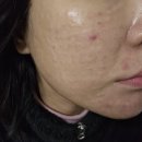 노원우태하피부과의원 | 노원역 피부과 리쥬란힐러 관리 받은 1회차 후기