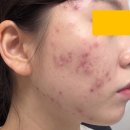 난화장품 - 사하구 비봉로 42 | 오블루크림 성인 여드름에 효과 있을까? 청소년 여드름 화장품 추천템 사용후기