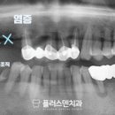 플러스덴치과의원 네이버블로그