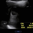도안누리여성의원 | 임산부 일기 - 임신 5주 차부터 8주 차까지 / 서브병원, 난황, 심장소리, 젤리곰 확인
