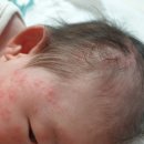 바르다,윤약국 | 지루성 두피염, 피부트러블로 고민인 분 찾습니다!!! 사망여우 샤워기 런칭 - 바르다윤선생 x 포세이온