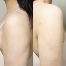 서울본탄탄의원 | 여름 몸매관리 팔뚝 바디온다 받은 사이즈 변화 후기