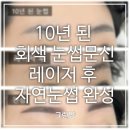 눈썹나라피부나라 | 10년 된 회색 눈썹문신 제거 후 반영구까지｜경산 눈썹문신 솔직 후기