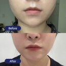 스테로이드 없는 윤곽주사 셀프시술 후기