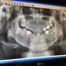 라이프치과의원 | 대구 동천동 라이프치과 사랑니 발치 후기