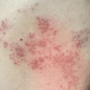 수산제일약국 | 옆구리 대상포진 통증 전염성 초기 증상 원인 진료과 병원 치료