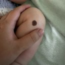 닥터신베스트의원 | 대구 닥터지니 선천성멜라닌세포모반 수술 후기｜아기 점 제거 당일 과정 총정리 (국소마취·포크랄...