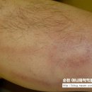 표재성 혈전 정맥염에 대해서- 순천 아나파의원 하지정맥류클리닉 이미지