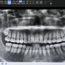 동대구치과의원 | 대구 톡톡사랑니치과의원 매복사랑니발치 후기