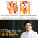 힘든 비세균성전립선염 완치를 향한 길위에 서계시다면 이미지