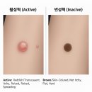 광토 | 편평사마귀 원인부터 면역 관리, 제거 비용, 제거 후 관리, 리터치, 그리고 연고 구매까지의 이야기