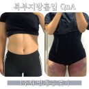 집밥멍선생 | 복부지방흡입 수술당일 통증, 붓기 1주차 후기