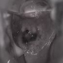 노들담한의원 | 자궁경부 이형성증 수술을 안 하면 무조건 암이 될까?