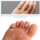 심상우 | 피부 사마귀(우목) 종류와 특징, 치료 사례 후기, 치료 방법
