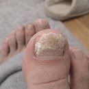 새희망약국 | 메디큐온 무좀 발톱 사용법 후기