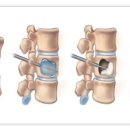 경피적 척추성형술[percutaneous vertebroplasty] 이미지