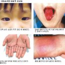 꿈크는아이병원 | 가와사키병 증상 및 치료 후기(고열 지속, 목 림프샘 부음, 배방꿈크는아이병원)