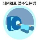 뇌MRI로 알수있는병 이미지