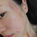 첼로 | 잠실피부과 콰트로 첼로 리프팅, 땅콩형 얼굴이 받은 후기
