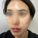 에스트라 아토베리어크림 md 병원 실비 후기 여드름 피부
