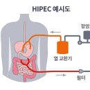 하이펙(HIPEC), 3-4기 난소암 치료에 효과 확인 이미지