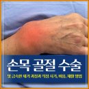 늘편한유항외과의원 | [공지] 손목 골절 수술 및 금속판 제거 과정과 적정 시기, 비용, 재활 방법