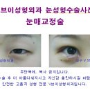 쌍꺼풀수술, 이중매몰 눈성형비용은? 대구성형외과 앞트임,뒷트임,눈매교정술 이미지