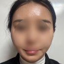 선정릉역피부과 중안부리프팅 네오페이스 내돈내산 후기