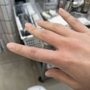 이노플러스성형외과의원 | 손가락 2도 화상 / 전주이노플러스성형외과의원