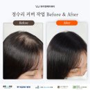 수원두피문신 정수리 탈모 헤어라인까지 자연스럽게 채운 후기