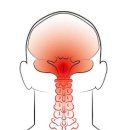 경추성 두통 어떻게 치료할 것인가 이미지