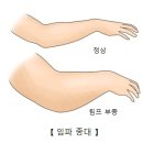 림프부종(Lymphedema) 순환기 질환이란? 이미지