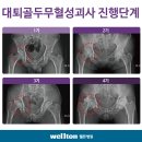 대퇴골두무혈성괴사/고관절수술/고관절인공관절/인공관절수술/인공관절치환술/고관절통증 이미지